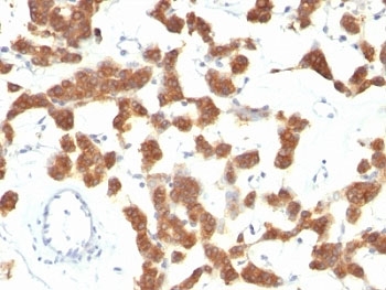 KRT18 / CK18 / Cytokeratin 18 Antibody - Formalin-fixed, paraffin-embedded human thyroid carcinoma stained with CK18 antibody (B23.1).  This image was taken for the unmodified form of this product. Other forms have not been tested.
