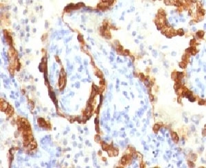 KRT18 / CK18 / Cytokeratin 18 Antibody - IHC testing of FFPE human lung carcinoma and Cytokeratin 18 antibody (clone CTKN18-1).  This image was taken for the unmodified form of this product. Other forms have not been tested.
