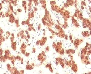 KRT18 / CK18 / Cytokeratin 18 Antibody - IHC testing of FFPE human thyroid carcinoma and Cytokeratin 18 antibody (clone CTKN18-1).  This image was taken for the unmodified form of this product. Other forms have not been tested.