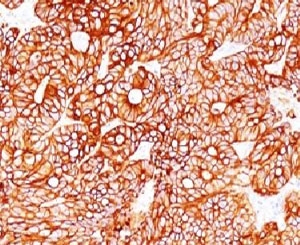 KRT18 / CK18 / Cytokeratin 18 Antibody - IHC testing of FFPE human colon carcinoma and Cytokeratin 18 antibody (clone CTKN18-1).  This image was taken for the unmodified form of this product. Other forms have not been tested.