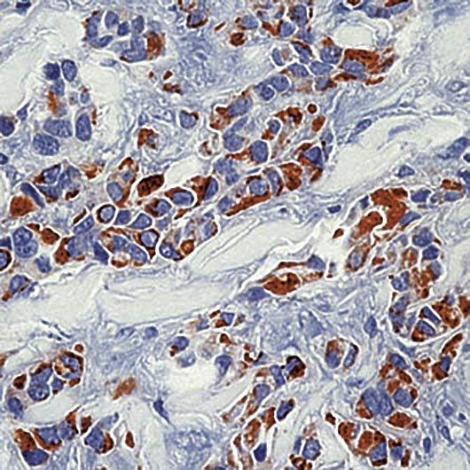 KRT18 / CK18 / Cytokeratin 18 Antibody - Formalin-fixed, paraffin-embedded human breast carcinoma stained with Cytokeratin 18 antibody.