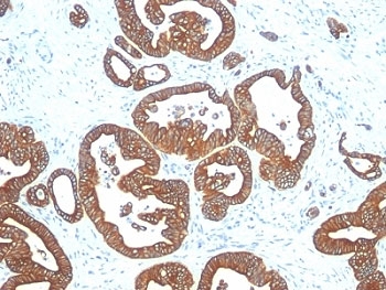 KRT18 / CK18 / Cytokeratin 18 Antibody - Formalin-fixed, paraffin-embedded human colon carcinoma stained with Cytokeratin 18 antibody (DE-K18).  This image was taken for the unmodified form of this product. Other forms have not been tested.