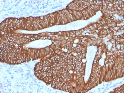 KRT18 / CK18 / Cytokeratin 18 Antibody - Formalin-fixed, paraffin-embedded human Colon Carcinoma stained with CK18 Rabbit Recombinant Monoclonal Antibody (KRT18/2808R).