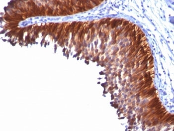KRT18 / CK18 / Cytokeratin 18 Antibody - Formalin-fixed, paraffin-embedded human bladder carcinoma stained with Cytokeratin 18 antibody (KRT18/834).  This image was taken for the unmodified form of this product. Other forms have not been tested.