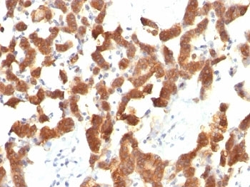 KRT18 / CK18 / Cytokeratin 18 Antibody - Formalin-fixed, paraffin-embedded human thyroid carcinoma stained with Cytokeratin 18 antibody (KRT18/834).  This image was taken for the unmodified form of this product. Other forms have not been tested.