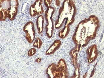 KRT18 / CK18 / Cytokeratin 18 Antibody - Formalin-fixed, paraffin-embedded human prostate carcinoma stained with Cytokeratin 18 antibody (KRT18/834).  This image was taken for the unmodified form of this product. Other forms have not been tested.