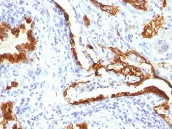 KRT18 / CK18 / Cytokeratin 18 Antibody - Formalin-fixed, paraffin-embedded human lung carcinoma stained with Cytokeratin 18 antibody (KRT18/834).  This image was taken for the unmodified form of this product. Other forms have not been tested.
