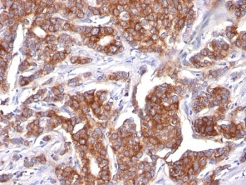 KRT18 / CK18 / Cytokeratin 18 Antibody - Formalin-fixed, paraffin-embedded human breast carcinoma stained with Cytokeratin 18 antibody (KRT18/834).  This image was taken for the unmodified form of this product. Other forms have not been tested.