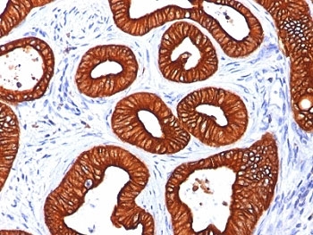 KRT18 / CK18 / Cytokeratin 18 Antibody - Formalin-fixed, paraffin-embedded human colon carcinoma stained with Cytokeratin 18 antibody (KRT18/834).  This image was taken for the unmodified form of this product. Other forms have not been tested.