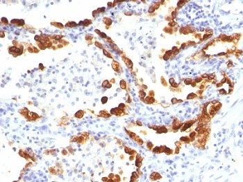 KRT18 / CK18 / Cytokeratin 18 Antibody - Formalin-fixed, paraffin-embedded human lung carcinoma stained with Cytokeratin 18 antibody (KRT18/835).  This image was taken for the unmodified form of this product. Other forms have not been tested.