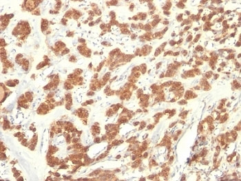 KRT18 / CK18 / Cytokeratin 18 Antibody - Formalin-fixed, paraffin-embedded human thyroid carcinoma stained with Cytokeratin 18 antibody (KRT18/835).  This image was taken for the unmodified form of this product. Other forms have not been tested.