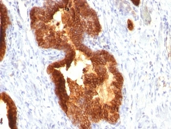 KRT18 / CK18 / Cytokeratin 18 Antibody - Formalin-fixed, paraffin-embedded human prostate carcinoma stained with Cytokeratin 18 antibody (KRT18/835).  This image was taken for the unmodified form of this product. Other forms have not been tested.