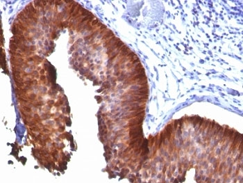 KRT18 / CK18 / Cytokeratin 18 Antibody - Formalin-fixed, paraffin-embedded human bladder carcinoma stained with Cytokeratin 18 antibody (KRT18/835).  This image was taken for the unmodified form of this product. Other forms have not been tested.