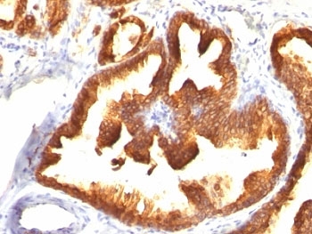 KRT18 / CK18 / Cytokeratin 18 Antibody - Formalin-fixed, paraffin-embedded human prostate carcinoma stained with CK18 antibody (KRT18/836).  This image was taken for the unmodified form of this product. Other forms have not been tested.
