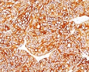 KRT18 / CK18 / Cytokeratin 18 Antibody - Formalin-fixed, paraffin-embedded human colon carcinoma stained with Cytokeratin 18 antibody.  This image was taken for the unmodified form of this product. Other forms have not been tested.
