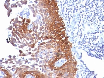 KRT18 / CK18 / Cytokeratin 18 Antibody - Formalin-fixed, paraffin-embedded human cervical carcinoma stained with Cytokeratin 18 antibody.  This image was taken for the unmodified form of this product. Other forms have not been tested.