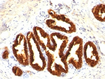KRT18 / CK18 / Cytokeratin 18 Antibody - Formalin-fixed, paraffin-embedded human prostate carcinoma stained with Cytokeratin 18 antibody.  This image was taken for the unmodified form of this product. Other forms have not been tested.