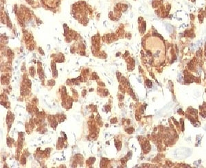 KRT18 / CK18 / Cytokeratin 18 Antibody - Formalin-fixed, paraffin-embedded human thyroid carcinoma stained with Cytokeratin 18 antibody.  This image was taken for the unmodified form of this product. Other forms have not been tested.