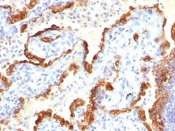 KRT18 / CK18 / Cytokeratin 18 Antibody - Formalin-fixed, paraffin-embedded human lung carcinoma stained with Cytokeratin 18 antibody.  This image was taken for the unmodified form of this product. Other forms have not been tested.