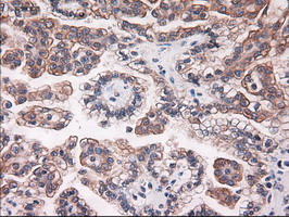 KRT18 / CK18 / Cytokeratin 18 Antibody - IHC of paraffin-embedded Carcinoma of kidney using anti-KRT18 mouse monoclonal antibody.