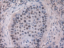 KRT18 / CK18 / Cytokeratin 18 Antibody - IHC of paraffin-embedded Carcinoma of lung using anti-KRT18 mouse monoclonal antibody.