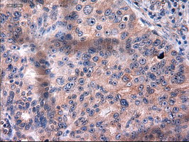 KRT18 / CK18 / Cytokeratin 18 Antibody - IHC of paraffin-embedded Adenocarcinoma of ovary using anti-KRT18 mouse monoclonal antibody.