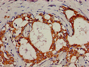 KRT18 / CK18 / Cytokeratin 18 Antibody - IHC image of KRT18 Antibody diluted at 1:800 and staining in paraffin-embedded human breast cancer performed on a Leica BondTM system. After dewaxing and hydration, antigen retrieval was mediated by high pressure in a citrate buffer (pH 6.0). Section was blocked with 10% normal goat serum 30min at RT. Then primary antibody (1% BSA) was incubated at 4°C overnight. The primary is detected by a biotinylated secondary antibody and visualized using an HRP conjugated SP system.