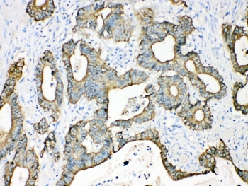 KRT18 / CK18 / Cytokeratin 18 Antibody - IHC testing of FFPE human intestinal cancer tissue with Cytokeratin 18 antibody at 1ug/ml. Required HIER: steam section in pH6 citrate buffer for 20 min and allow to cool prior to testing.