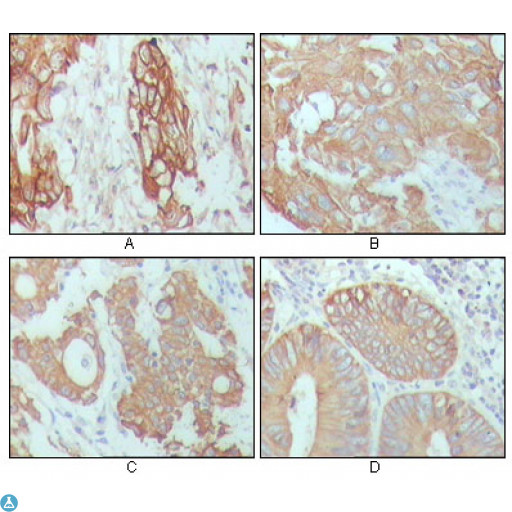 KRT18 / CK18 / Cytokeratin 18 Antibody - Immunohistochemistry (IHC) analysis of paraffin-embedded Human Breast Carcinoma (A), hepatocarcinoma (B), stomach cancer (C) and colon cancer tissue (D), showing cytoplasmic location with DAB staining using Cytokeratin 18 Monoclonal Antibody.