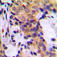 KRT18 / CK18 / Cytokeratin 18 Antibody - Immunohistochemical analysis of Cytokeratin 18 staining in human breast cancer formalin fixed paraffin embedded tissue section. The section was pre-treated using heat mediated antigen retrieval with sodium citrate buffer (pH 6.0). The section was then incubated with the antibody at room temperature and detected using an HRP conjugated compact polymer system. DAB was used as the chromogen. The section was then counterstained with hematoxylin and mounted with DPX.