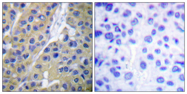 KRT18 / CK18 / Cytokeratin 18 Antibody - Immunohistochemistry analysis of paraffin-embedded human breast carcinoma, using Keratin 18 (Phospho-Ser33) Antibody. The picture on the right is blocked with the phospho peptide.