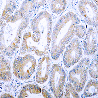 KRT18 / CK18 / Cytokeratin 18 Antibody - Immunohistochemical analysis of Cytokeratin 18 (pS33) staining in human colon cancer formalin fixed paraffin embedded tissue section. The section was pre-treated using heat mediated antigen retrieval with sodium citrate buffer (pH 6.0). The section was then incubated with the antibody at room temperature and detected using an HRP conjugated compact polymer system. DAB was used as the chromogen. The section was then counterstained with hematoxylin and mounted with DPX.