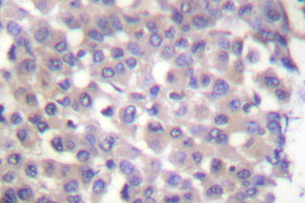 KRT18 / CK18 / Cytokeratin 18 Antibody - IHC of Cytokeratin 18 (P27) pAb in paraffin-embedded human breast carcinoma tissue.