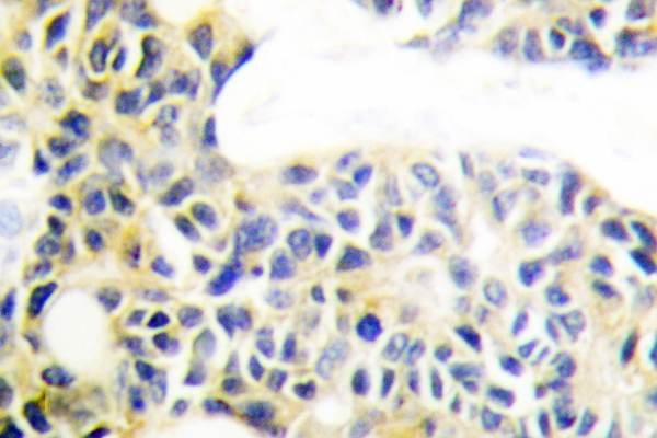 KRT18 / CK18 / Cytokeratin 18 Antibody - IHC of Cytokeratin 18 (S48) pAb in paraffin-embedded human breast carcinoma tissue.