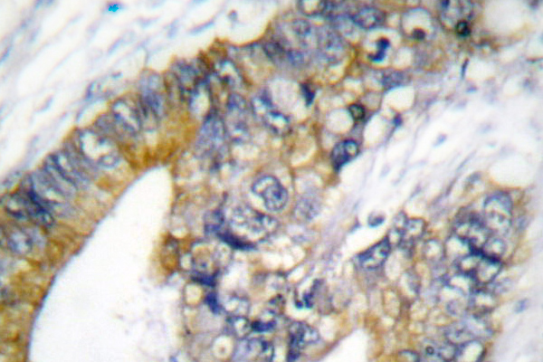 KRT18 / CK18 / Cytokeratin 18 Antibody - IHC of Cytokeratin 18 (T410) pAb in paraffin-embedded human lung carcinoma tissue.