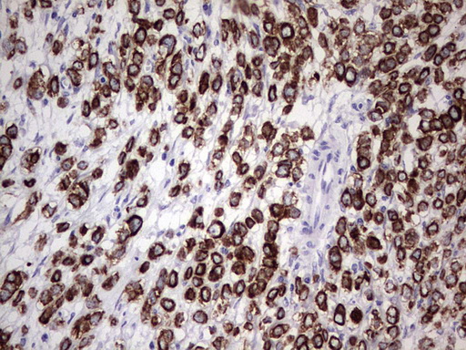 KRT19 / CK19 / Cytokeratin 19 Antibody - IHC of paraffin-embedded Adenocarcinoma of Human breast tissue using anti-KRT19 mouse monoclonal antibody. (Heat-induced epitope retrieval by 1 mM EDTA in 10mM Tris, pH8.5, 120°C for 3min).