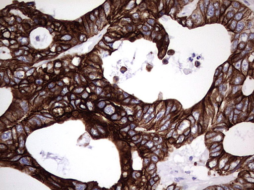 KRT19 / CK19 / Cytokeratin 19 Antibody - IHC of paraffin-embedded Adenocarcinoma of Human colon tissue using anti-KRT19 mouse monoclonal antibody. (Heat-induced epitope retrieval by 1 mM EDTA in 10mM Tris, pH8.5, 120°C for 3min).