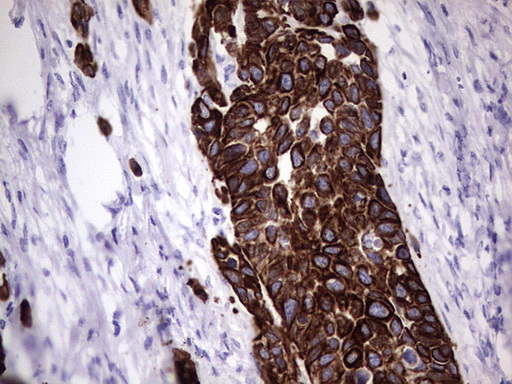 KRT19 / CK19 / Cytokeratin 19 Antibody - IHC of paraffin-embedded Carcinoma of Human kidney tissue using anti-KRT19 mouse monoclonal antibody. (Heat-induced epitope retrieval by 1 mM EDTA in 10mM Tris, pH8.5, 120°C for 3min).