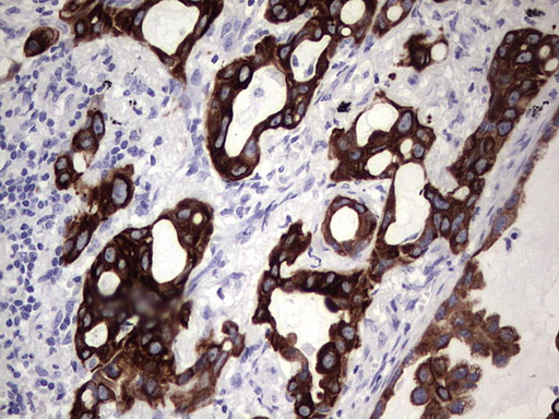 KRT19 / CK19 / Cytokeratin 19 Antibody - IHC of paraffin-embedded Carcinoma of Human lung tissue using anti-KRT19 mouse monoclonal antibody. (Heat-induced epitope retrieval by 1 mM EDTA in 10mM Tris, pH8.5, 120°C for 3min).