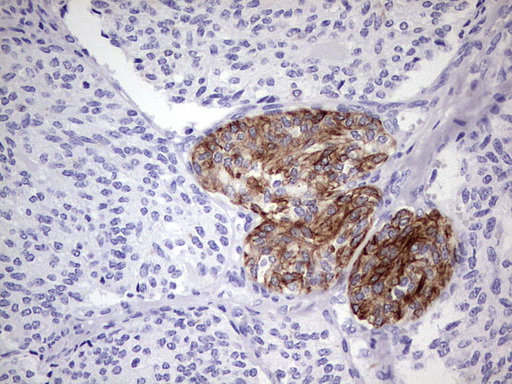 KRT19 / CK19 / Cytokeratin 19 Antibody - IHC of paraffin-embedded Human thyroid tissue using anti-KRT19 mouse monoclonal antibody. (Heat-induced epitope retrieval by 1 mM EDTA in 10mM Tris, pH8.5, 120°C for 3min).