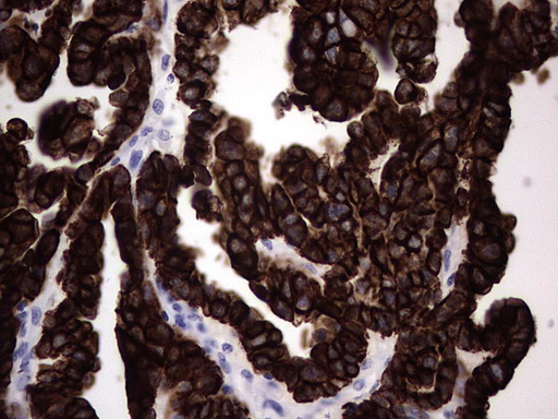 KRT19 / CK19 / Cytokeratin 19 Antibody - IHC of paraffin-embedded Adenocarcinoma of Human ovary tissue using anti-KRT19 mouse monoclonal antibody. (Heat-induced epitope retrieval by 1 mM EDTA in 10mM Tris, pH8.5, 120°C for 3min).