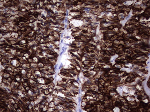 KRT19 / CK19 / Cytokeratin 19 Antibody - IHC of paraffin-embedded Carcinoma of Human thyroid tissue using anti-KRT19 mouse monoclonal antibody. (Heat-induced epitope retrieval by 1 mM EDTA in 10mM Tris, pH8.5, 120°C for 3min).