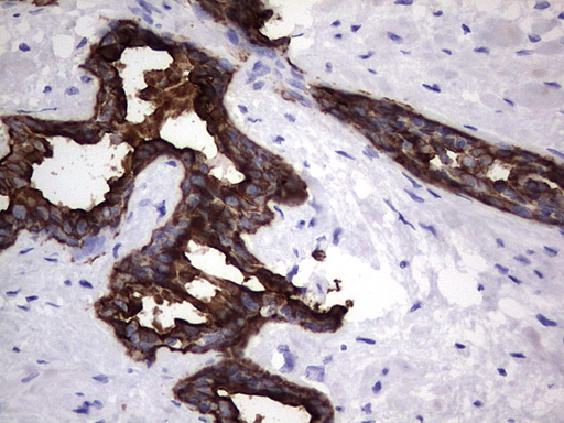 KRT19 / CK19 / Cytokeratin 19 Antibody - IHC of paraffin-embedded Human prostate tissue using anti-KRT19 mouse monoclonal antibody. (Heat-induced epitope retrieval by 1 mM EDTA in 10mM Tris, pH8.5, 120°C for 3min).