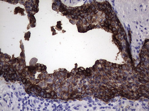 KRT19 / CK19 / Cytokeratin 19 Antibody - IHC of paraffin-embedded Carcinoma of Human prostate tissue using anti-KRT19 mouse monoclonal antibody. (Heat-induced epitope retrieval by 1 mM EDTA in 10mM Tris, pH8.5, 120°C for 3min).