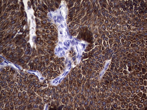 KRT19 / CK19 / Cytokeratin 19 Antibody - IHC of paraffin-embedded Carcinoma of Human bladder tissue using anti-KRT19 mouse monoclonal antibody. (Heat-induced epitope retrieval by 1 mM EDTA in 10mM Tris, pH8.5, 120°C for 3min).