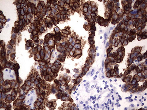 KRT19 / CK19 / Cytokeratin 19 Antibody - IHC of paraffin-embedded Adenocarcinoma of Human ovary tissue using anti-KRT19 mouse monoclonal antibody. (Heat-induced epitope retrieval by 1 mM EDTA in 10mM Tris, pH8.5, 120°C for 3min).