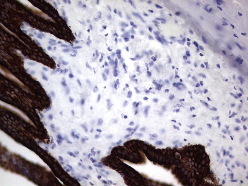 KRT19 / CK19 / Cytokeratin 19 Antibody - IHC of paraffin-embedded Carcinoma of Human pancreas tissue using anti-KRT19 mouse monoclonal antibody. (Heat-induced epitope retrieval by 1 mM EDTA in 10mM Tris, pH8.5, 120°C for 3min).
