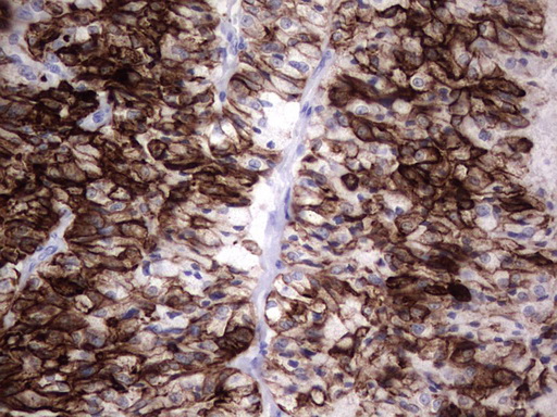 KRT19 / CK19 / Cytokeratin 19 Antibody - IHC of paraffin-embedded Human thyroid tissue using anti-KRT19 mouse monoclonal antibody. (Heat-induced epitope retrieval by 1 mM EDTA in 10mM Tris, pH8.5, 120°C for 3min).