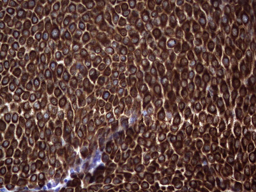 KRT19 / CK19 / Cytokeratin 19 Antibody - IHC of paraffin-embedded Carcinoma of Human bladder tissue using anti-KRT19 mouse monoclonal antibody. (Heat-induced epitope retrieval by 1 mM EDTA in 10mM Tris, pH8.5, 120°C for 3min).