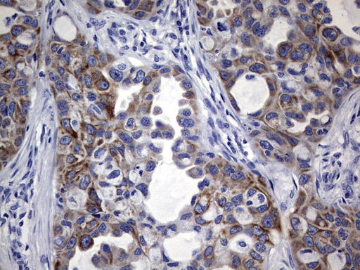 KRT19 / CK19 / Cytokeratin 19 Antibody - Immunohistochemical staining of paraffin-embedded Carcinoma of Human lung tissue using anti-KRT19 mouse monoclonal antibody. (Heat-induced epitope retrieval by 1 mM EDTA in 10mM Tris, pH8.5, 120C for 3min,
